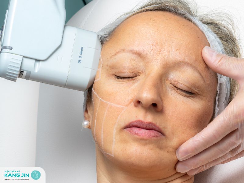 Phương pháp xóa nếp nhăn trên trán bằng Hifu