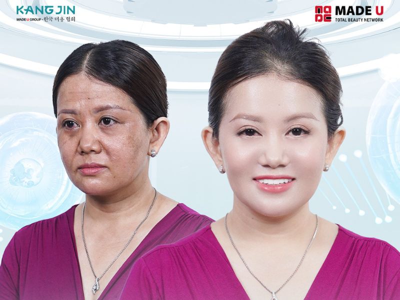 xóa nếp nhăn trên mặt