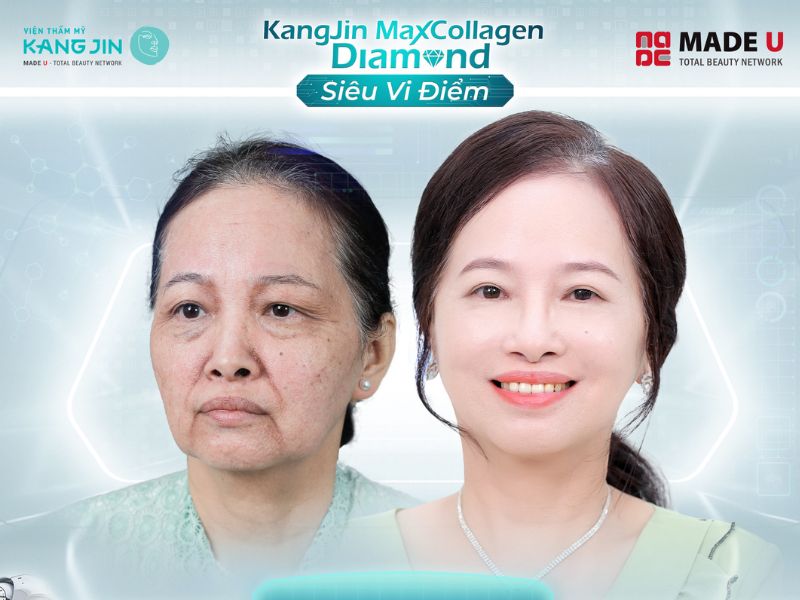 cách chọn liệu pháp xóa nhăn