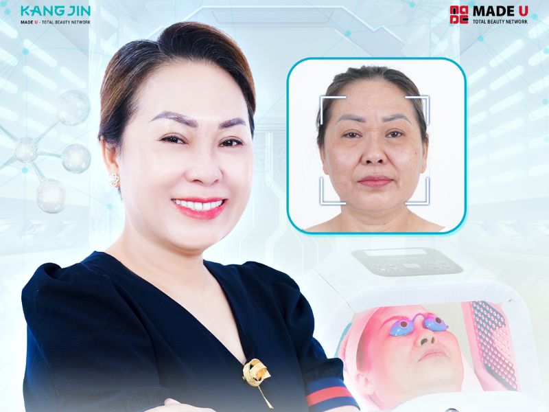 Tổng hợp các cách xóa nhăn trán hiệu quả mà bạn cần biết