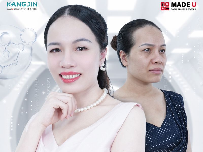 Làn da của chị Tử Vy trước và sau liệu trình trẻ hóa Sejung Maxcollagen Diamond Siêu Vi Điểm