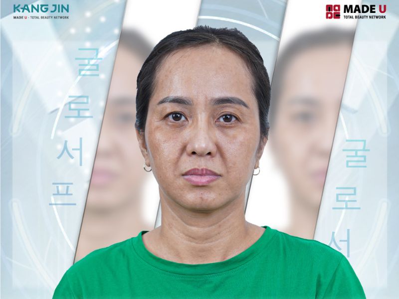 Làn da với đầy đủ các dấu hiệu lão hóa của chị Mỹ Lệ