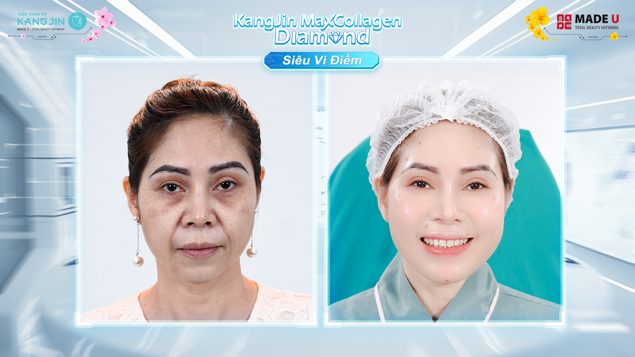 Chị Phương Linh trước và sau khi thực hiện liệu trình