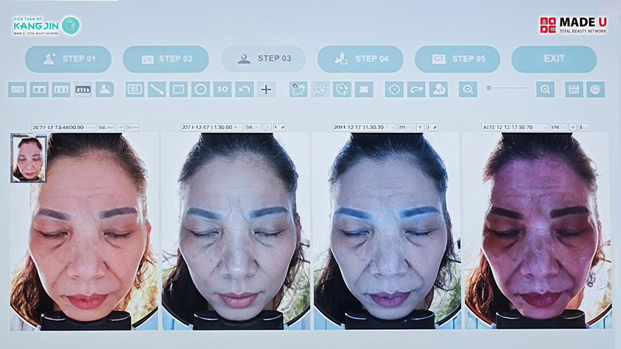 kết quả soi da bằng Skin Lab 5D