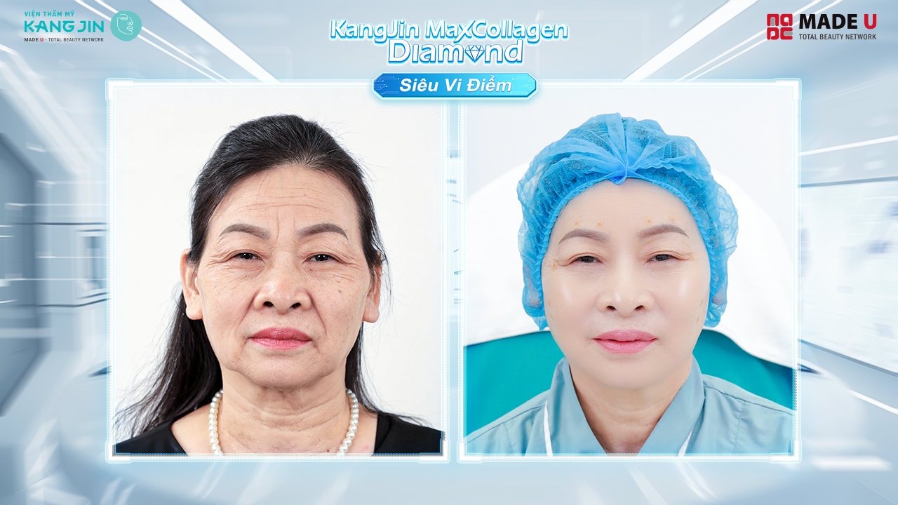 Hình ảnh cô Hoa trước và sau liệu trình 