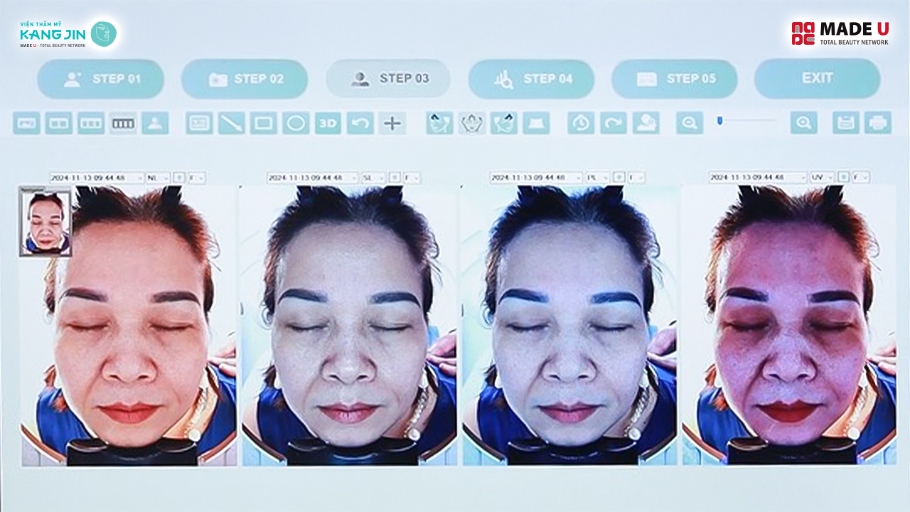 kết quả soi da bằng Skin Lab 5D