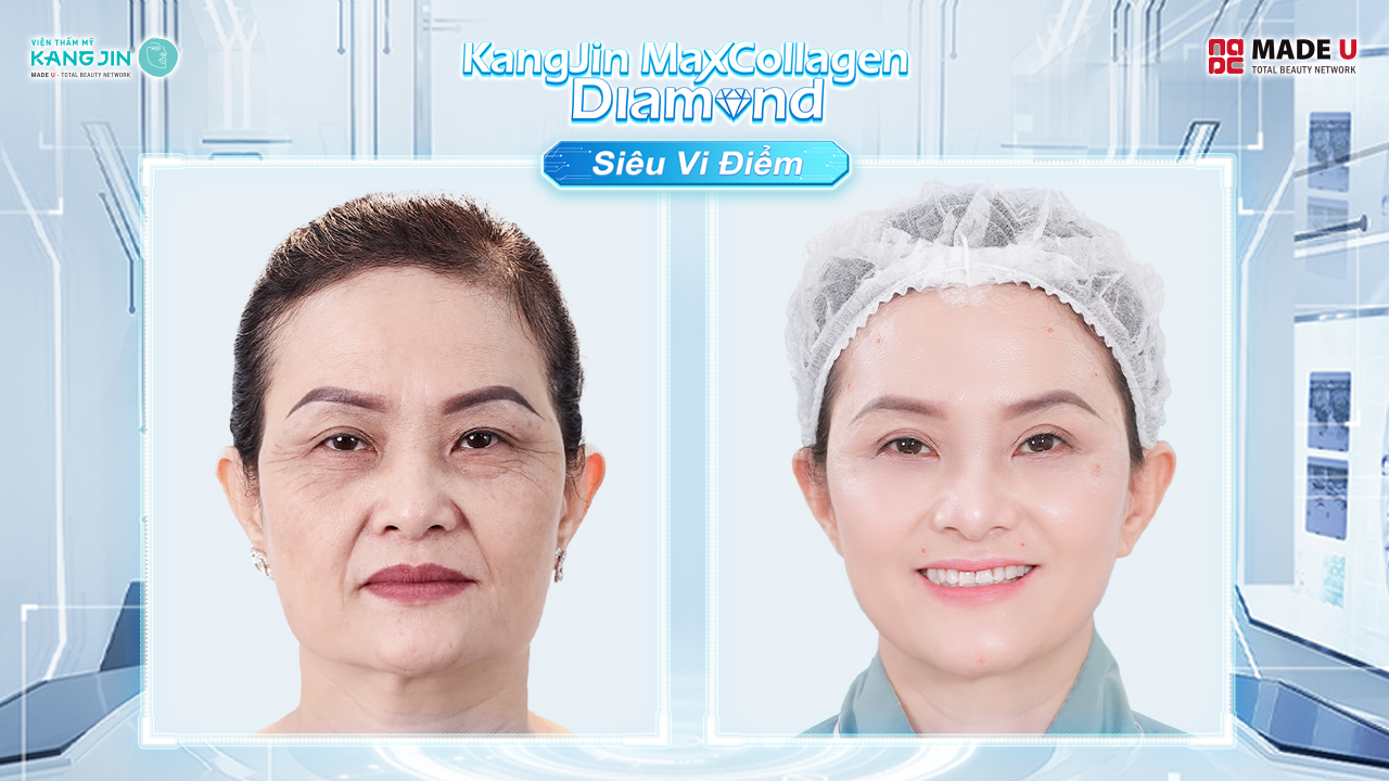 Làn da cô Bích Thảo sau liệu trình 