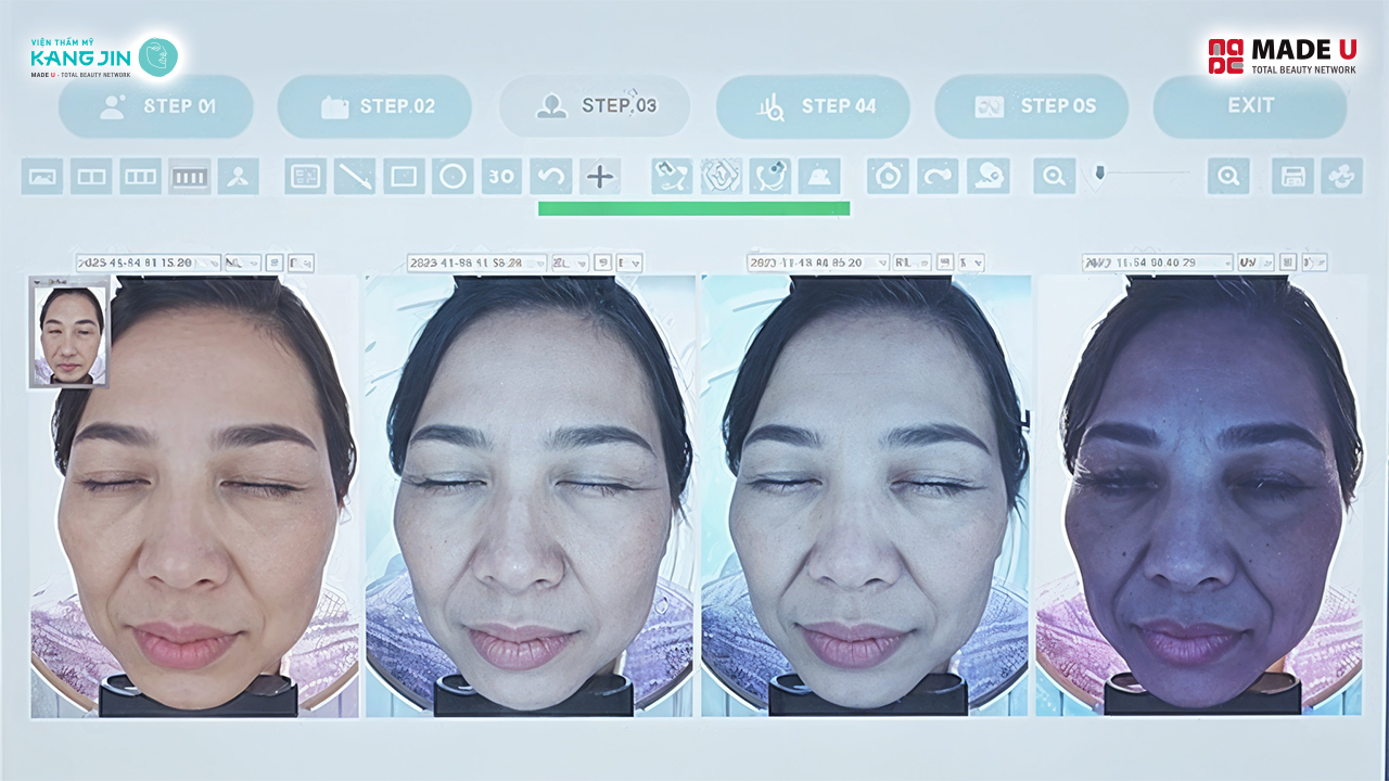kết quả soi da bằng Skin Lab 5D