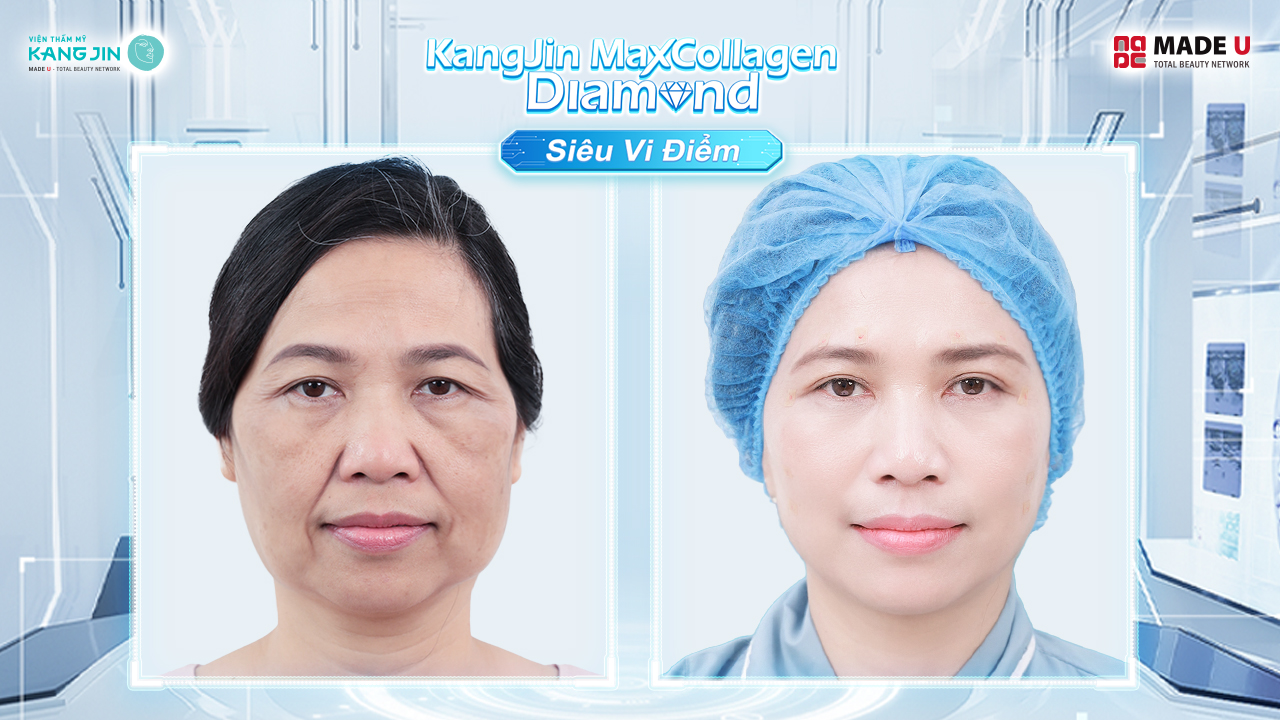 cô Kim Anh trước và sau liệu trình