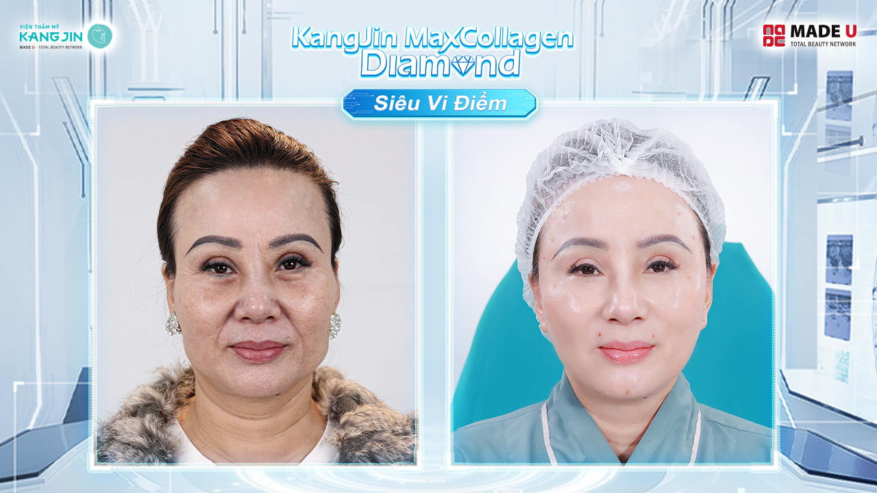 chị Bella trước và sau khi thực hiện liệu trình