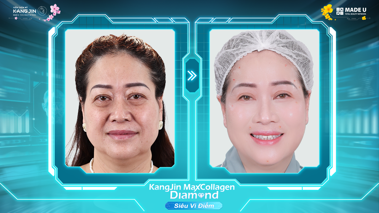 tình trạng da của cô Thanh trước và sau khi điều trị