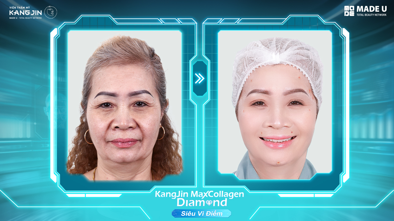 hình ảnh cô Bùi Hiền trước và sau liệu trình trẻ hóa