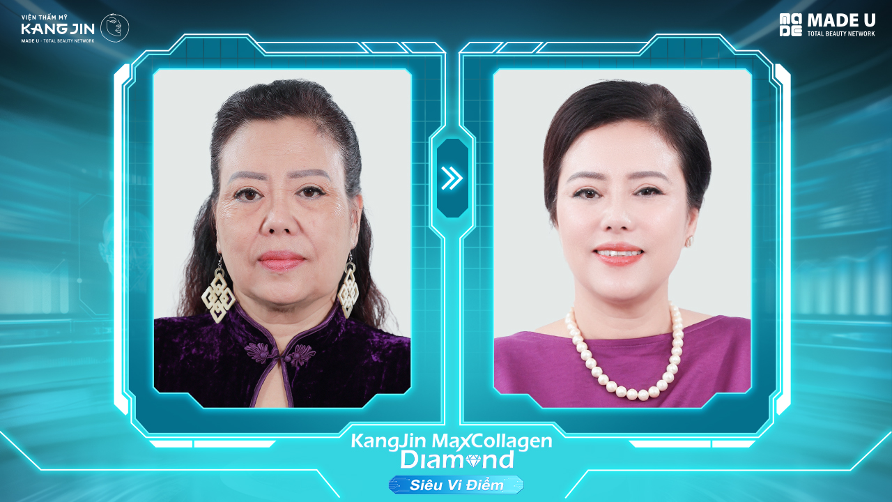 Tình trạng da của của chị Ngọc Điệp khi kết thúc liệu trình