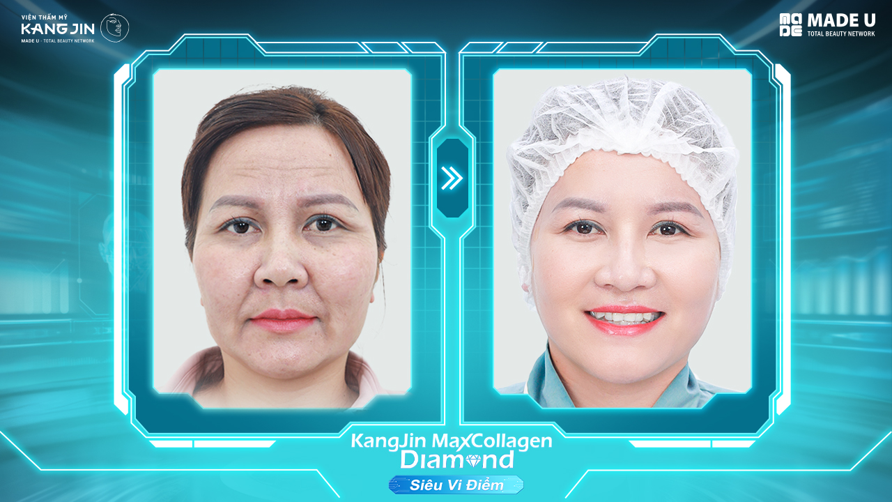 Tình trạng da của chị Thanh Thúy trước và sau khi thực hiện liệu trình