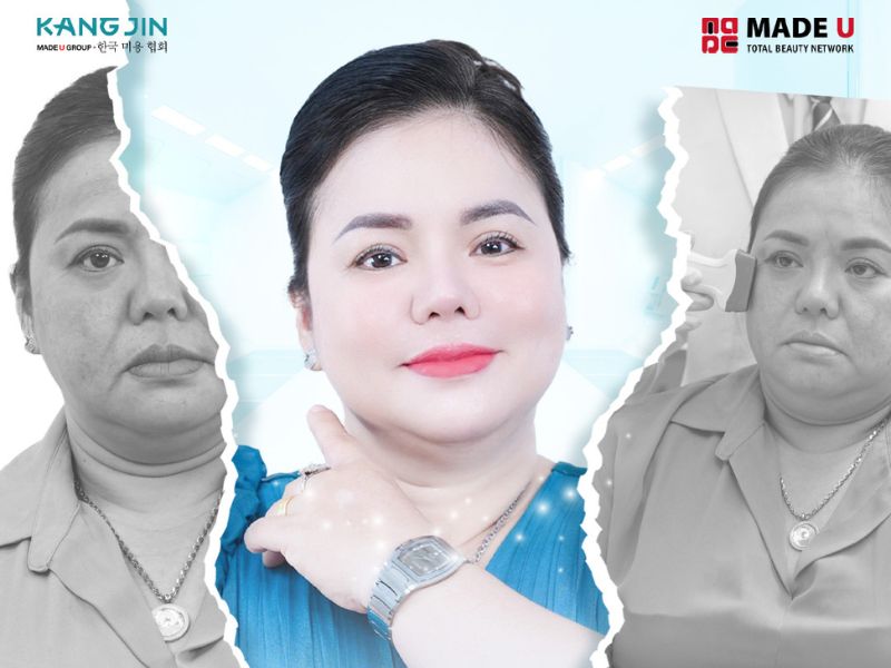 Làn da của chị Bích Thủy thay đổi rõ rệt trước và sau khi thực hiện trẻ hóa tại KangJin 