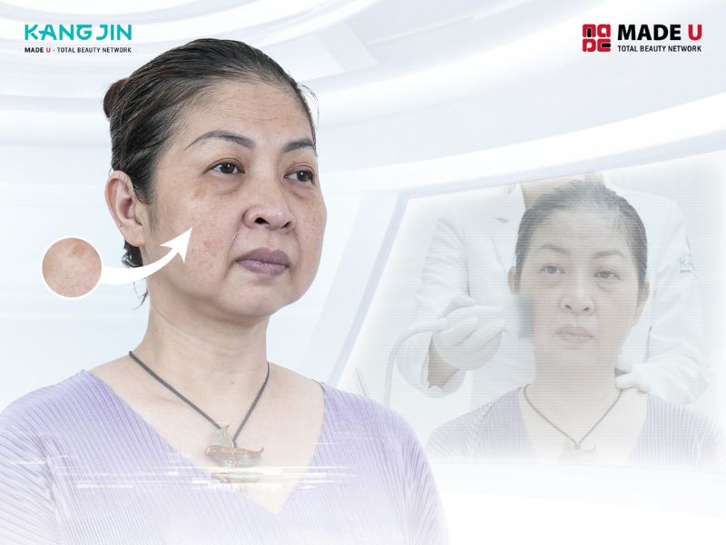 Làn da lão hóa cấp độ 4 của cô Mỹ Chi