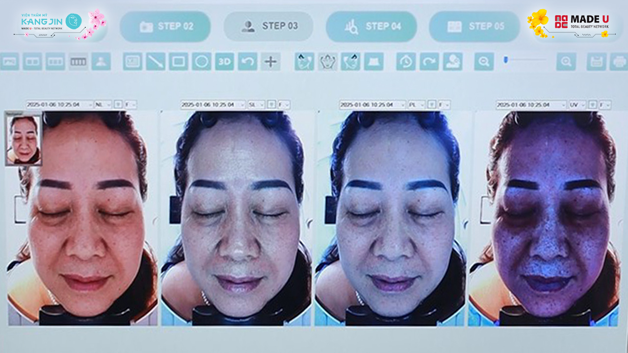 kết quả soi da bằng Skin Lab 5D