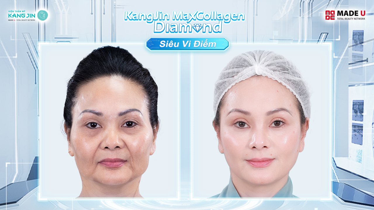 chị Mint Hà trước và sau khi thực hiện liệu trình