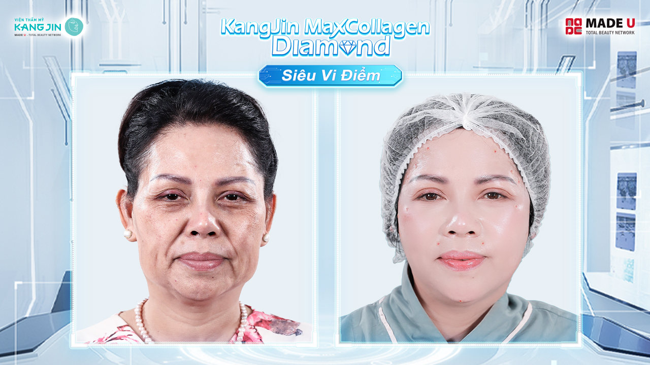 chị Thủy trước và sau điều trị