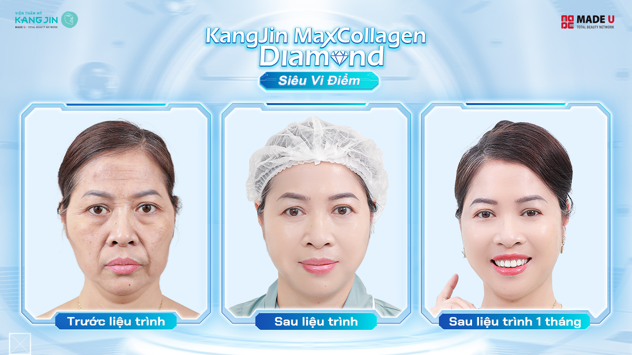 cô Kim Ngân lấy lại làn da rạng rỡ chỉ sau 1 liệu trình