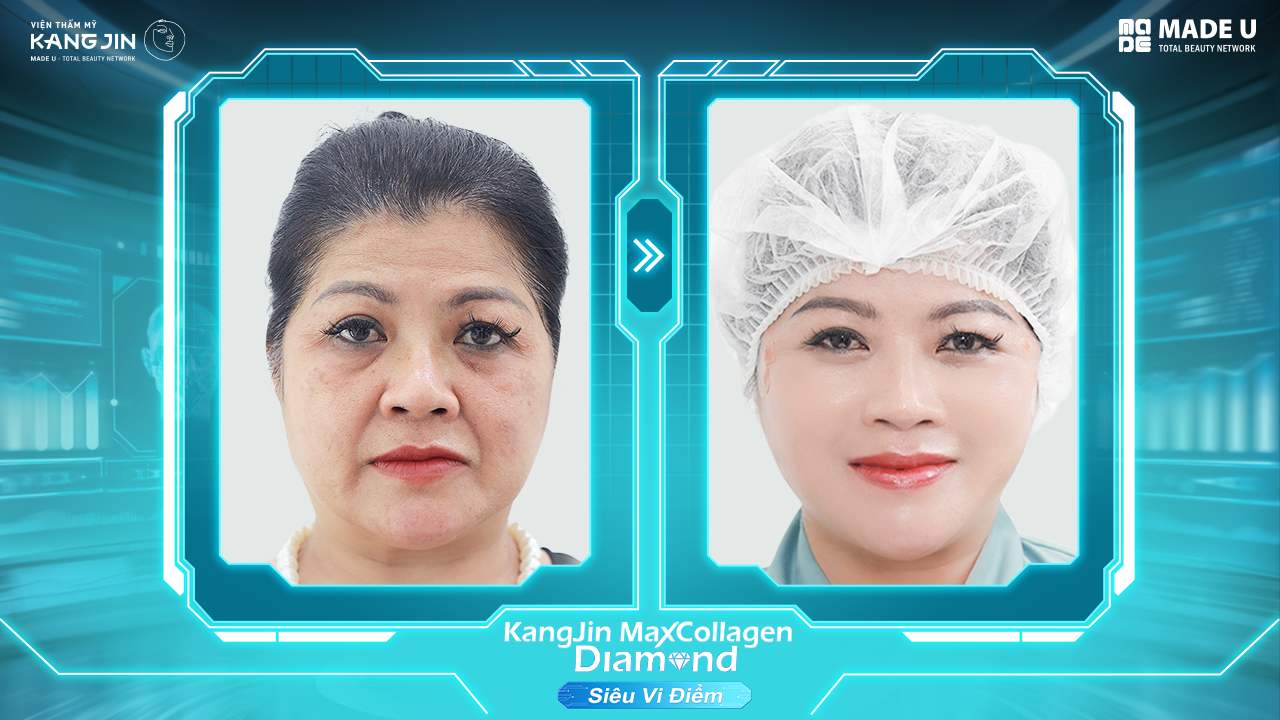 làn da chị Trang trước và sau điều trị