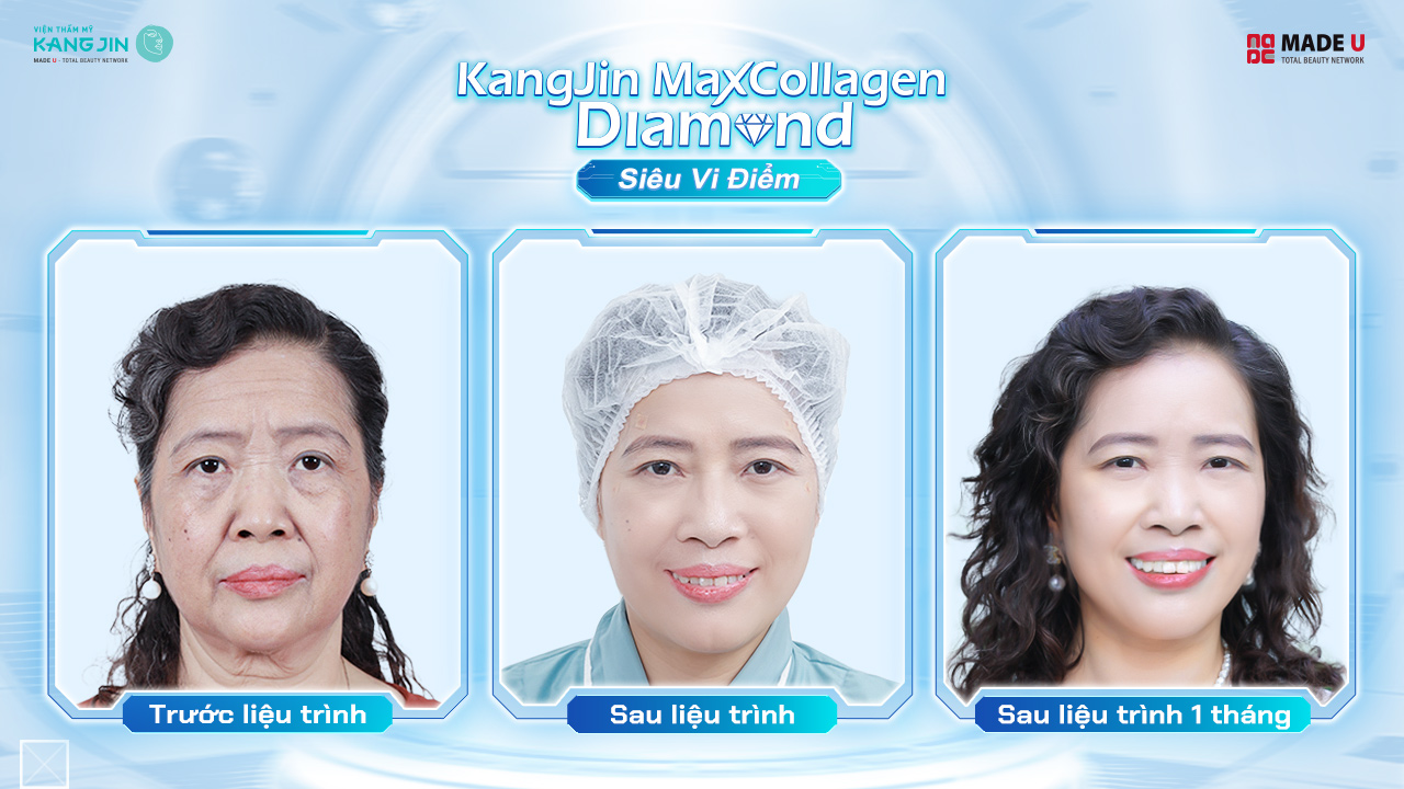 cô Đào Ánh cải thiện lão hóa chỉ sau 1 liệu trình ngắn