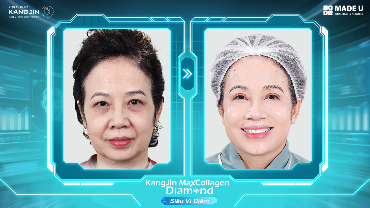 tình trạng da của chị Phương Huyền trước và sau điều trị