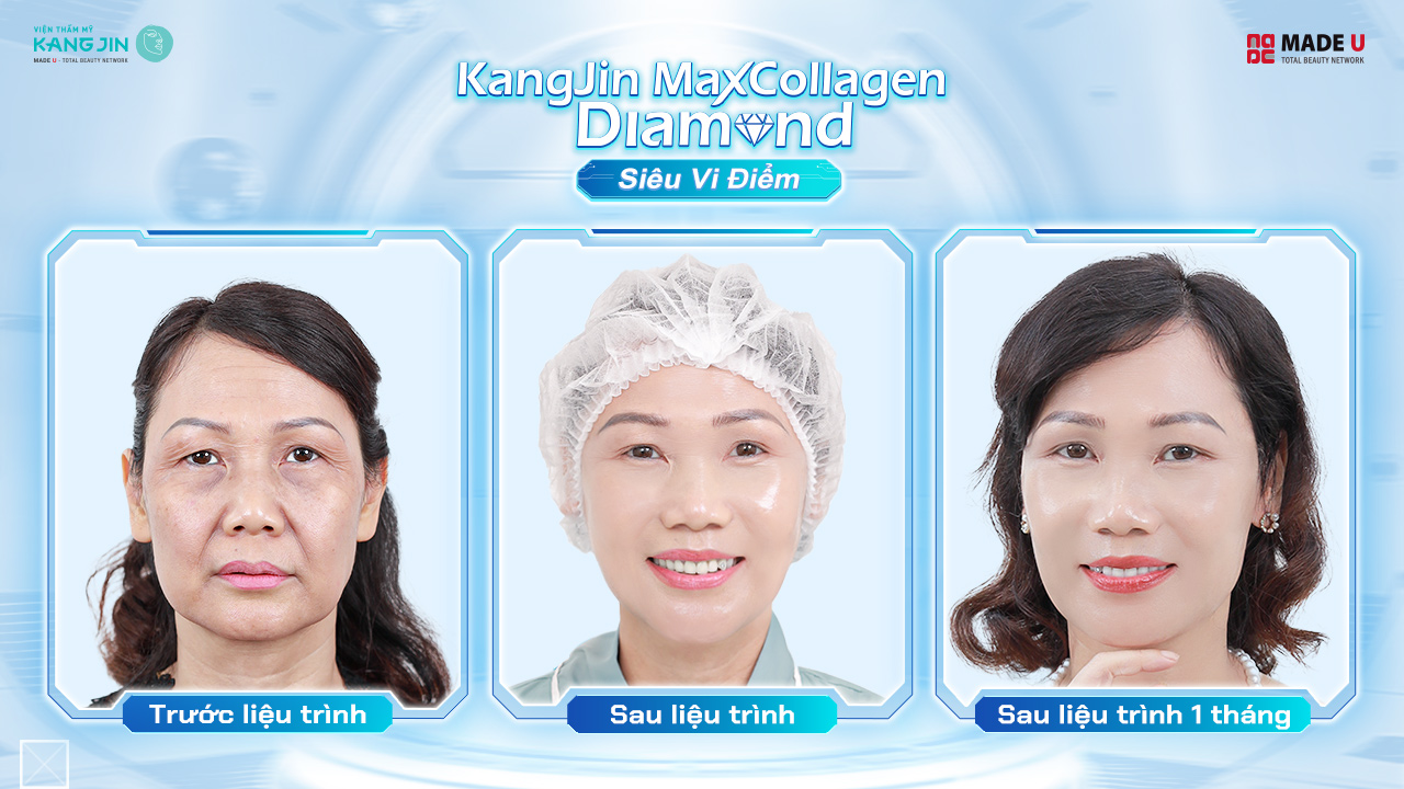 cô Hương Lan rạng rỡ sau 1 liệu trình ngắn