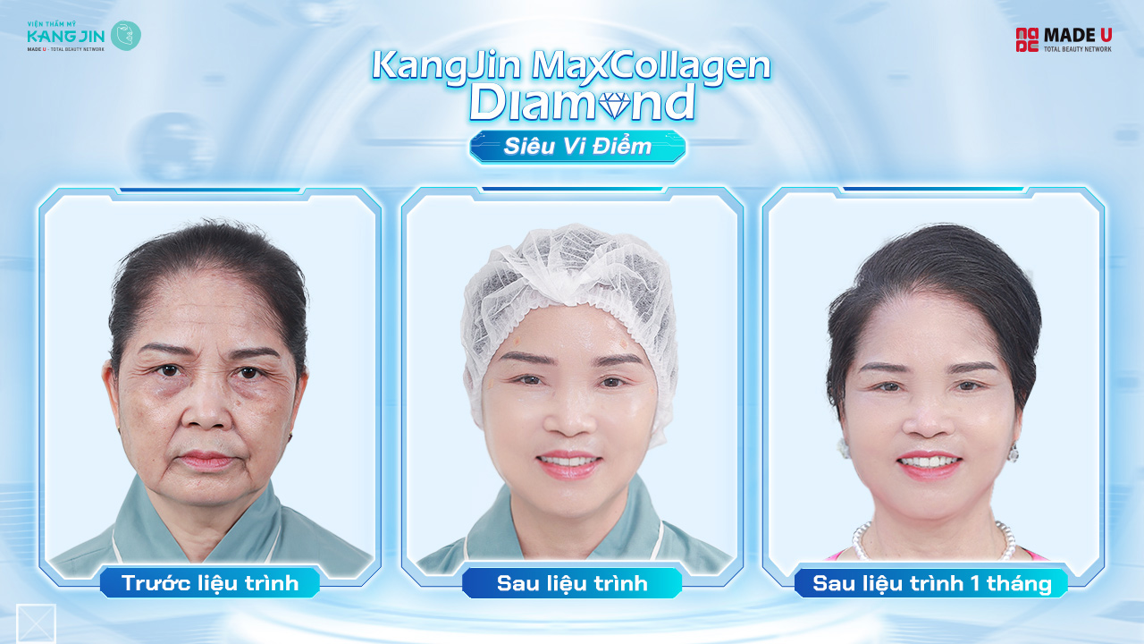 cô Ngọc Vân cải thiện lão hóa chỉ sau 1 liệu trình ngắn