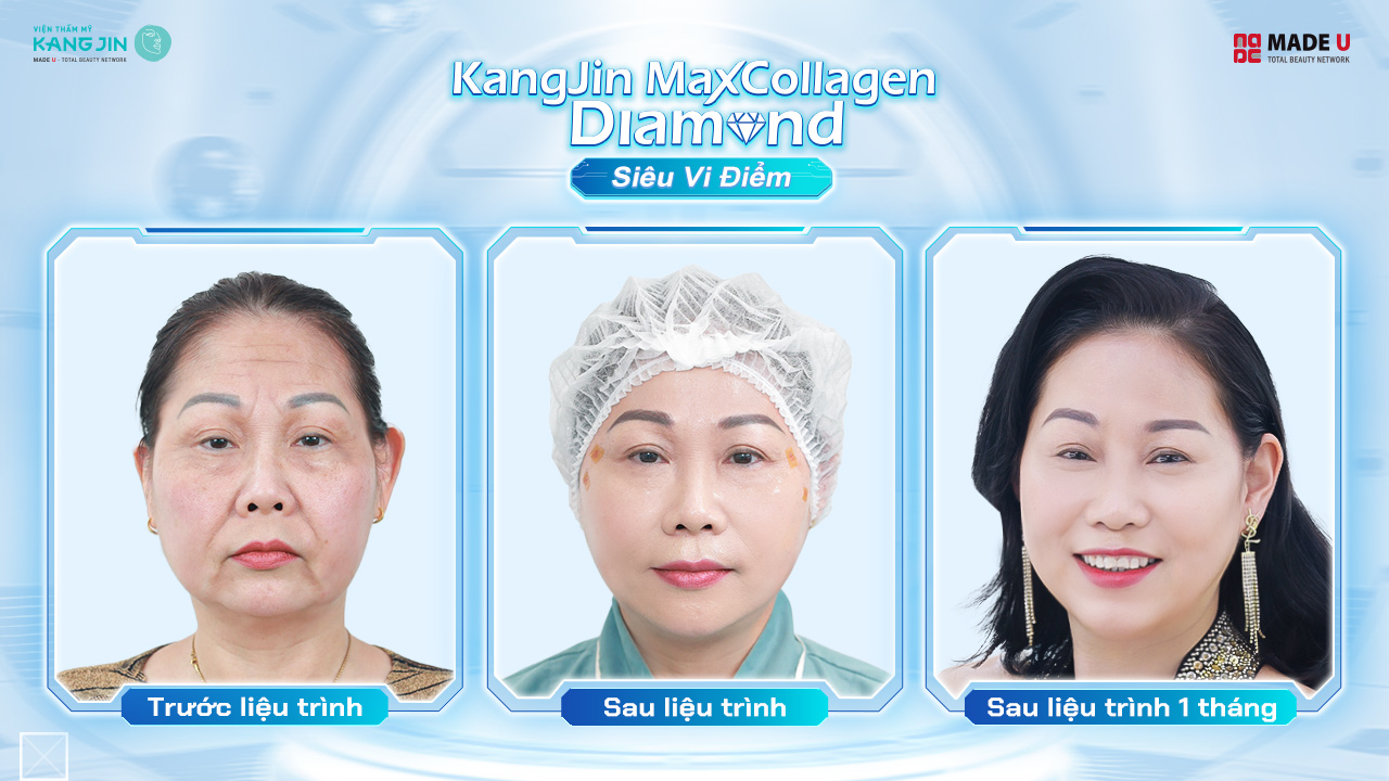 kết quả trẻ hóa của cô Selina sau 1 tháng