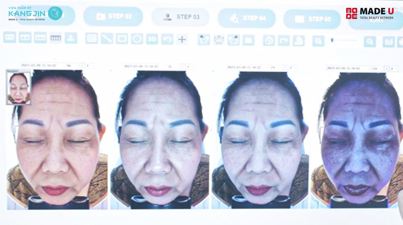 kết quả soi da bằng Skin Lab 5D