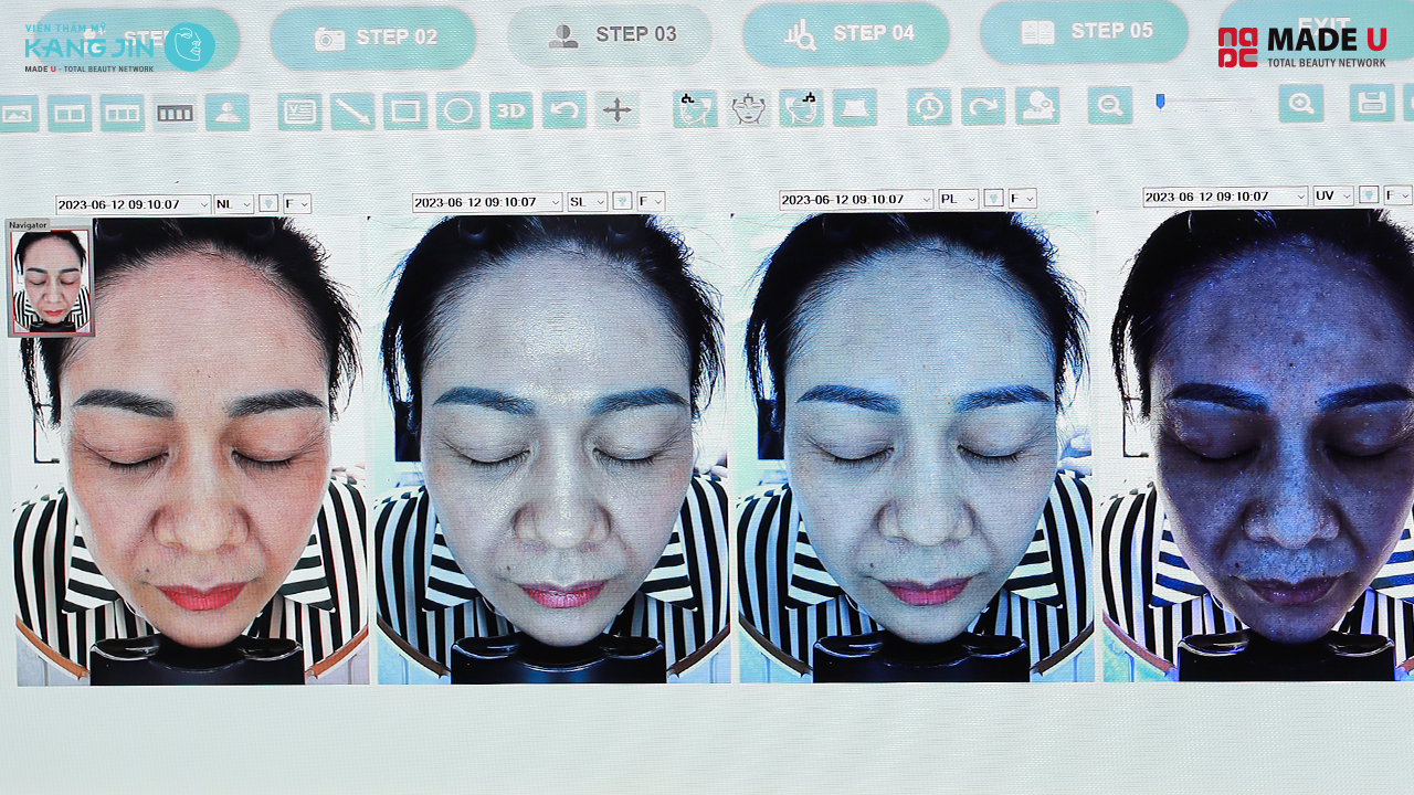 kết quả khi soi da bằng Skin Lab 5D