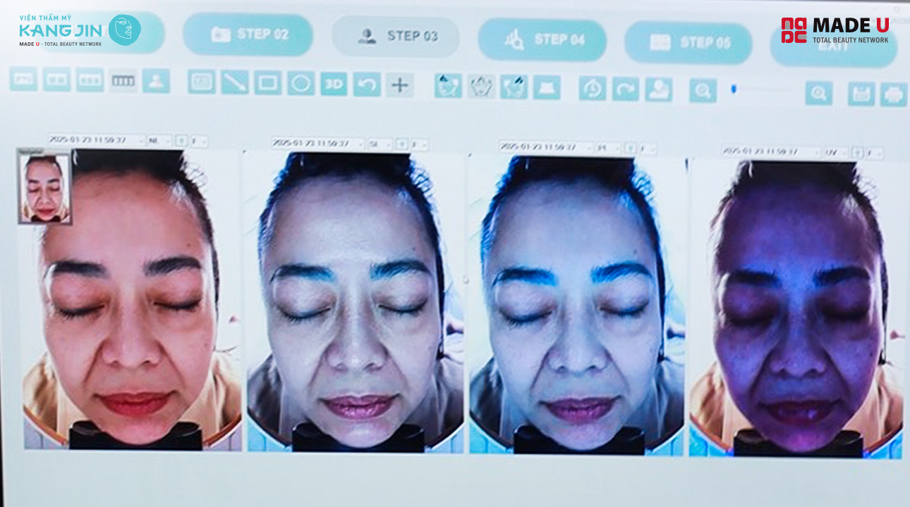 kết quả soi da bằng Skin Lab 5D