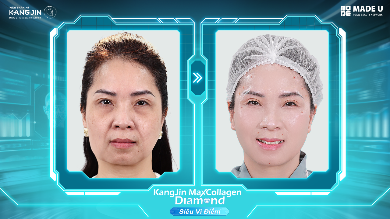 làn da chị Hiền trước và sau khi thực hiện liệu trình