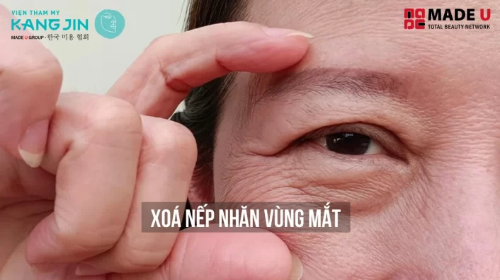 Xóa Nếp Nhăn Vùng Mắt