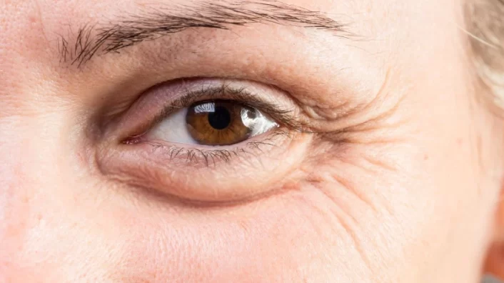 Cách Giảm Nếp Nhăn Ở Mắt