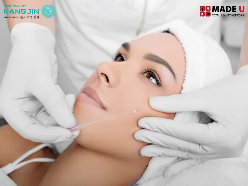 Căng chỉ nâng cơ mặt là phương pháp không phẫu thuật