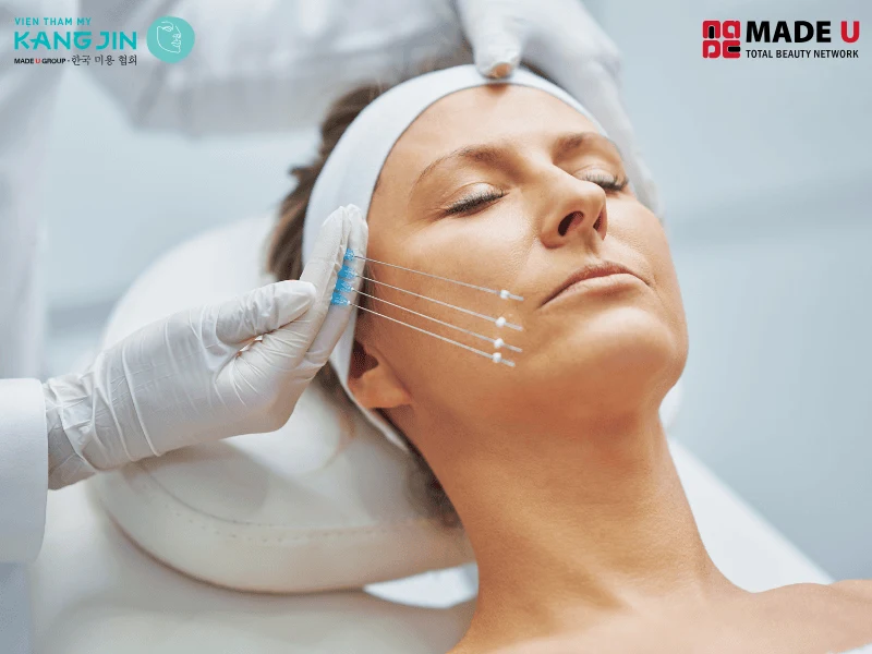 Căng chỉ nâng cơ mặt không phẫu thuật, không để lại sẹo