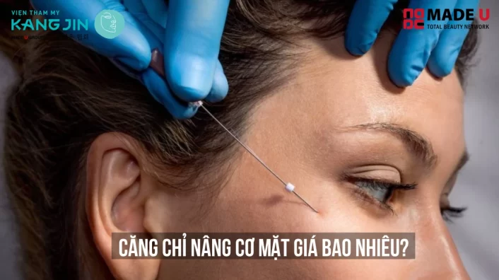 Căng chỉ nâng cơ mặt giá bao nhiêu