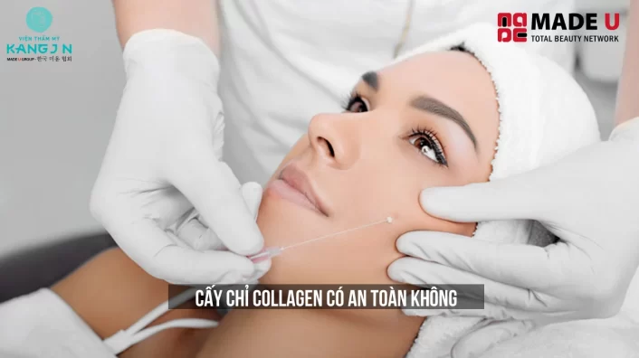 Cấy Chỉ Collagen Có An Toàn Không