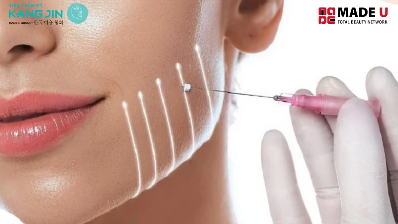 Cấy chỉ collagen làm đầy má hóp gồm 6 bước cơ bản