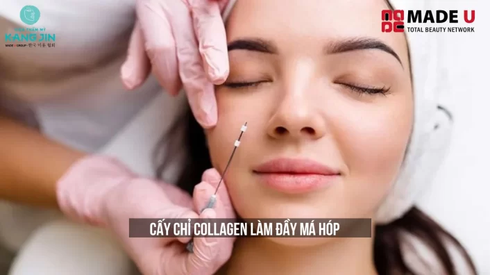 Cấy Chỉ Collagen Làm Đầy Má Hóp