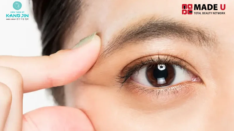 Rãnh cười ở quanh mắt xuất hiện khi bạn cười hoặc nheo mắt.