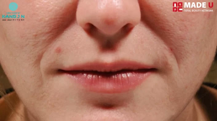 các loại rãnh cười