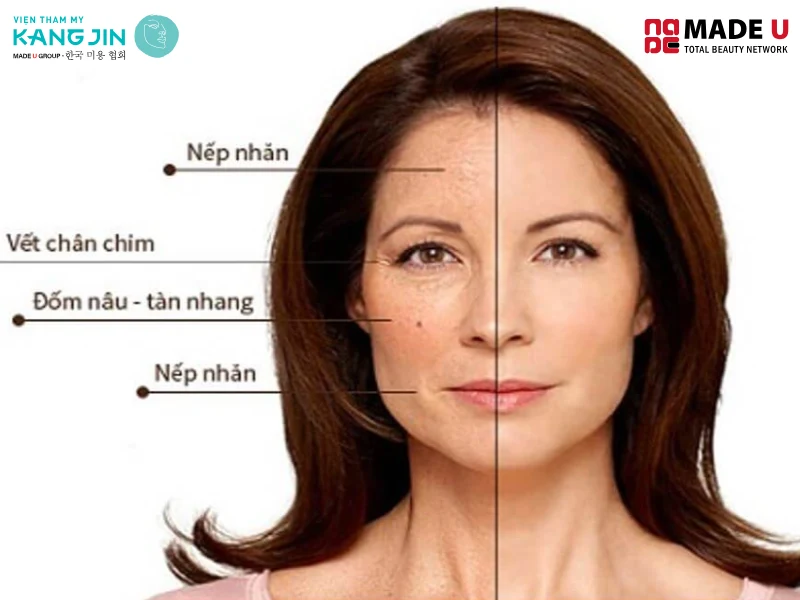 Lượng Estrogen giảm dần kéo theo cả sự thiếu hụt collagen gây ra tình trạng lão hoá da