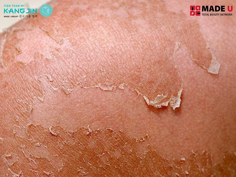 Dấu hiệu cháy nắng như: da ửng hồng hay đỏ và cảm thấy da ấm hoặc nóng khi chạm vào