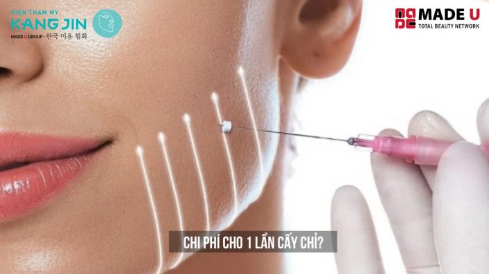 chi phí cho 1 lần cấy chỉ