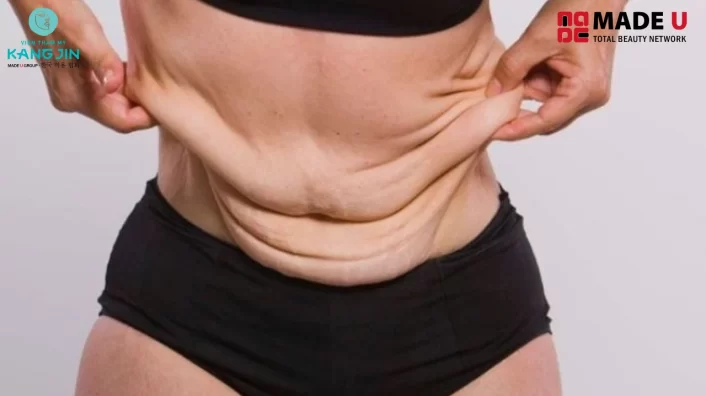 Tập các bài thể dục như Yoga, gym giúp giảm da chùng nhão sau giảm cân