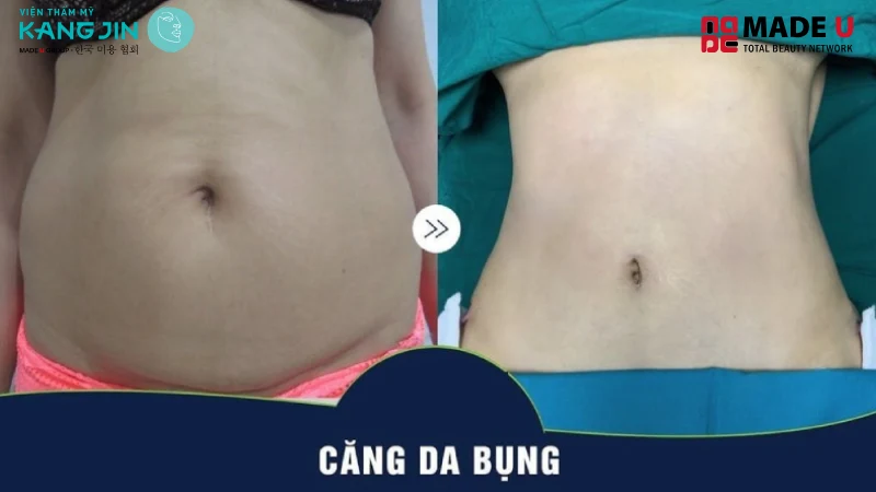 da chùng nhão sau giảm cân