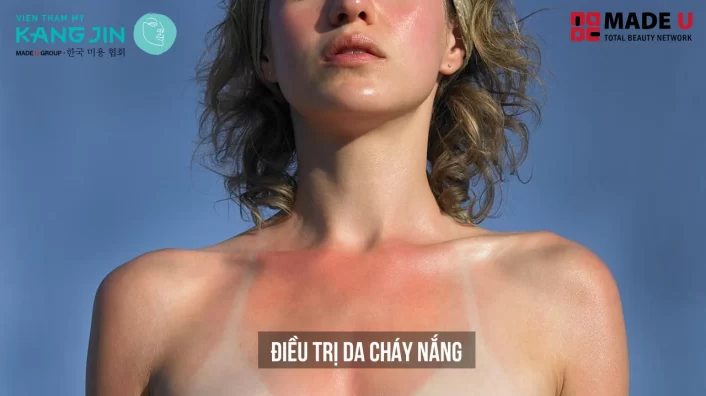điều trị da cháy nắng